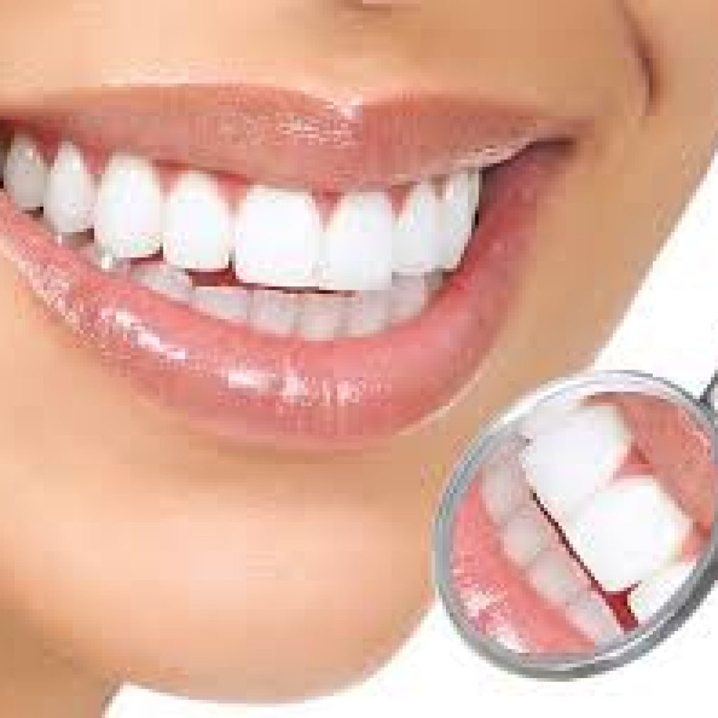 Tips Cara Memutihkan Gigi Dengan Cepat secara alami